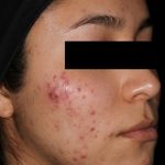 AviClear Before & After Patient #1670